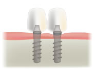 2本のインプラント