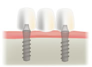 3本のインプラントをブリッジタイプでした場合