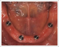 インプラント埋入後