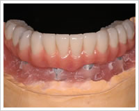 当日使用高性能仮歯