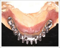 高精度チタンフレーム