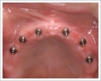 インプラント埋入後