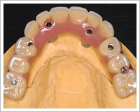 当日使用高性能仮歯