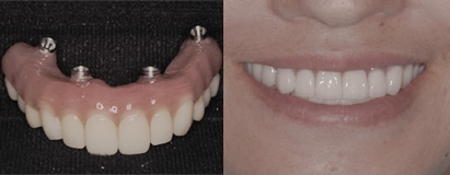 仮歯の装着・調整